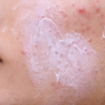 Complete Guide to Acne Treatment