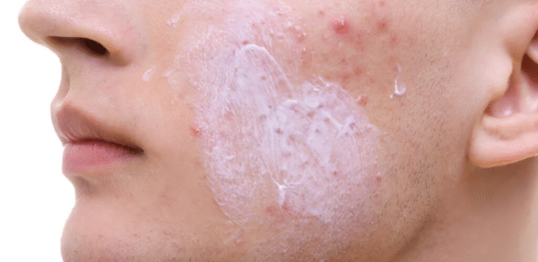 Complete Guide to Acne Treatment